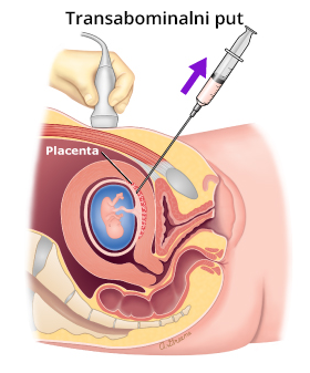 Izvođenje Horiocenteze transabominalnim putem kako bi se otkrio Daunov sindrom