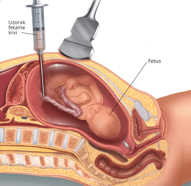 Izvođenje Kordocenteze kako bi se otkrio Daunov sindrom