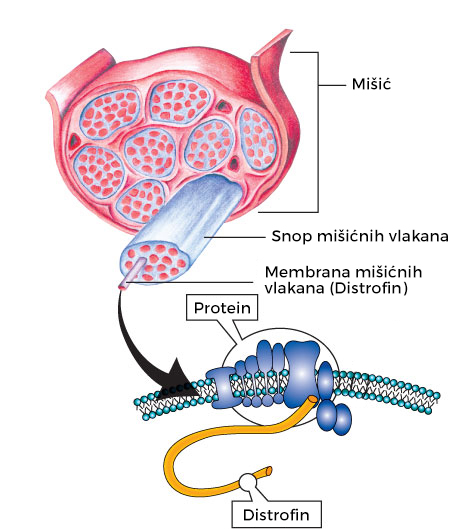 Mišićna distrofija - Dišenova mišićna distrofija